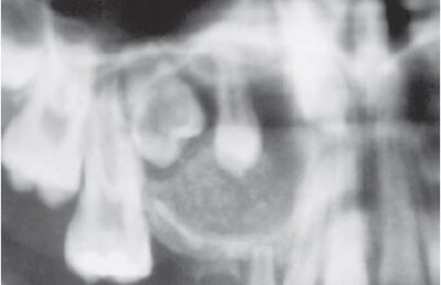 Aot Radiograph Adenomatoid Odontogenic Tumor - Dr. Paul Mirdamadi DDS