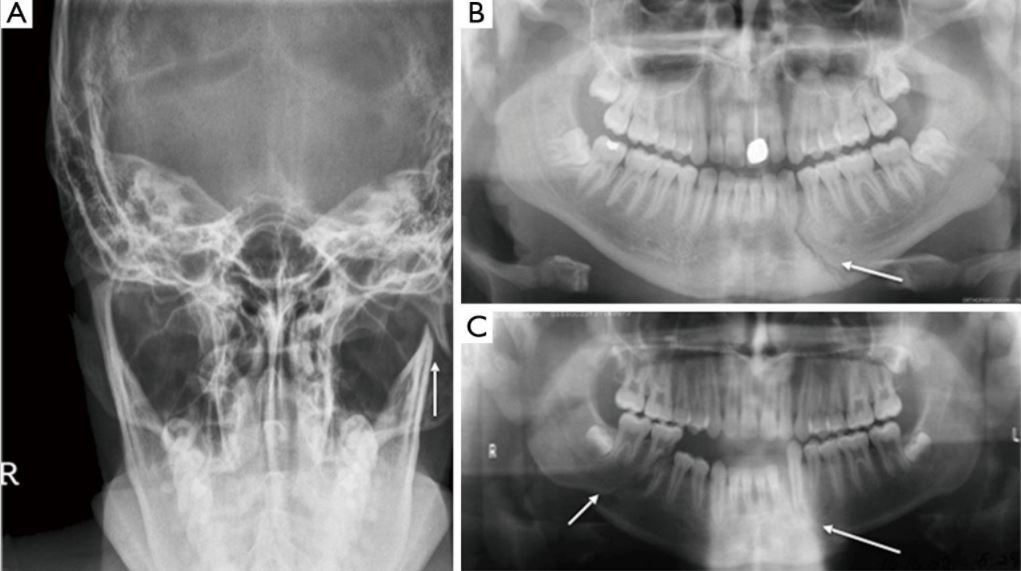 Panoramic and Towne view radiographs of right mandibu- lar angle