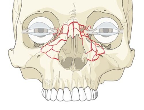 Naso-Orbital-Ethmoid Complex