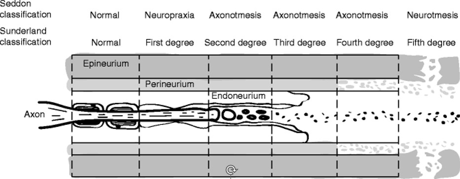 Seddon and Sunderland Classification of Nerve Injury