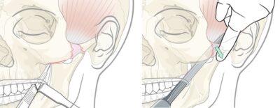 Midface - Dr. Paul Mirdamadi DDS
