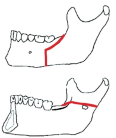 Bilateral Sagittal Split Osteotomy BSSO Dr. Paul Mirdamadi DDS