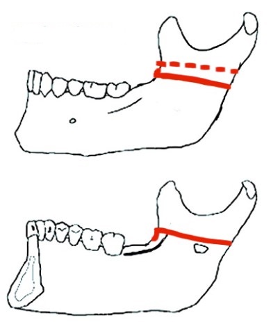 Bilateral Sagittal Split Osteotomy BSSO Dr. Paul Mirdamadi DDS