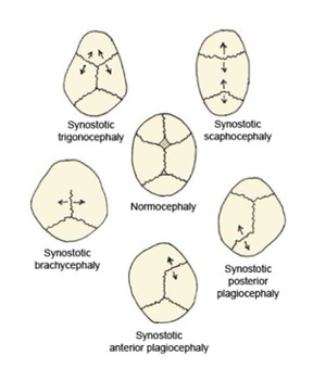 Craniosynostosis