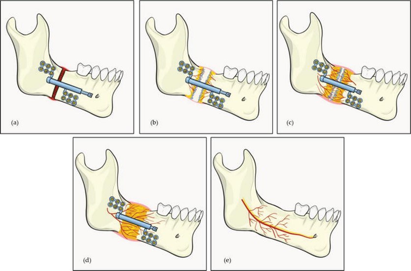 Distraction Osteogenesis