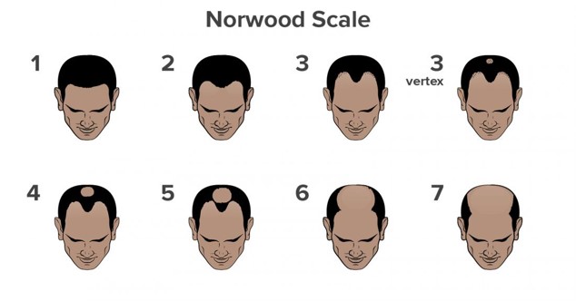 Norwood Scale