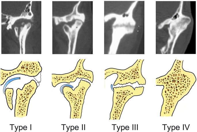 Temporomandibular Joint Phases of Ankylosis