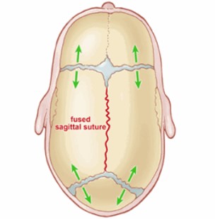 Virchow's Law and Cranial Sutures