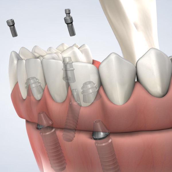 Dental Implants Treatment Concept