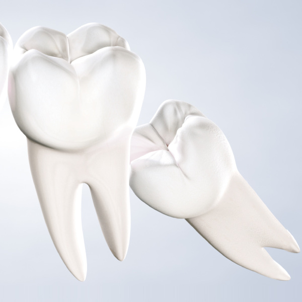 Wisdom Teeth Removal